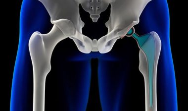 Metal Hip Implant Lawsuit